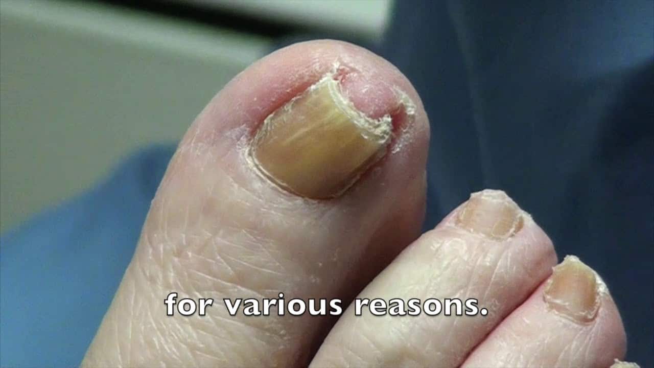 One Curved Big Toenail, One Loose Big Toenail Dr Nail Nipper