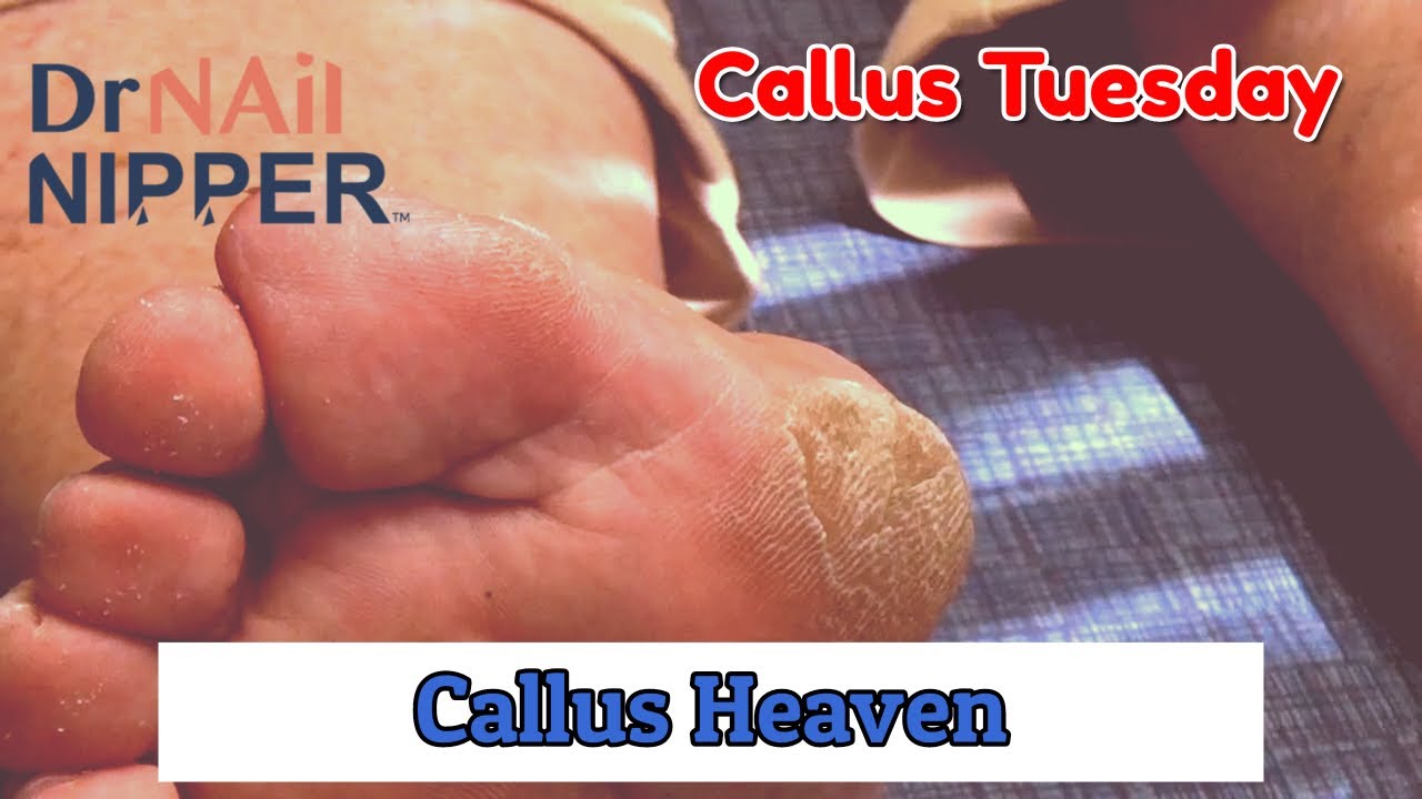 4 Minutes of Callus Heaven [Callus Tuesday] (2020) 1
