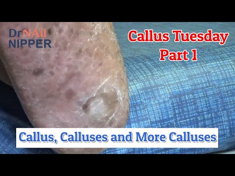 Callus, Calluses and More Calluses on Left Foot - Part 1 [Callus Tuesday] (2020) 1