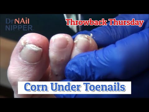 Corns under Toenails [Throwback Thursday] 1