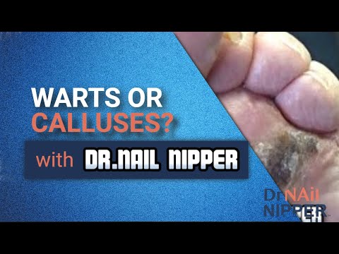 Warts or Calluses? It is Emily [Callus Tuesday] (2020) 1