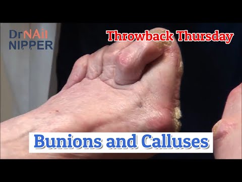 Bunions and Calluses (and Dogs) [Throwback Thursday] 1