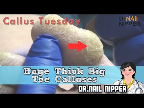 Huge Thick Big Toe Calluses #28 - Dr Nail Nipper's Callus Tuesday 1