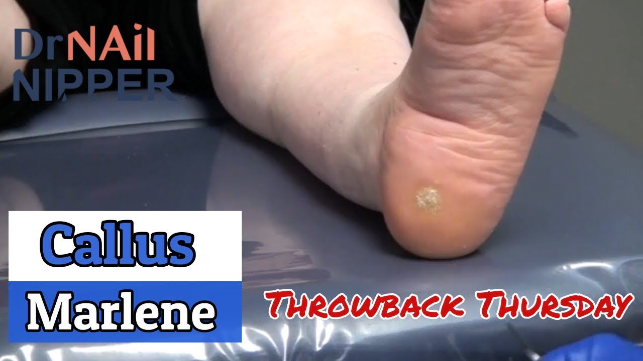 Callus with Marlene [Throwback Thursday] 4