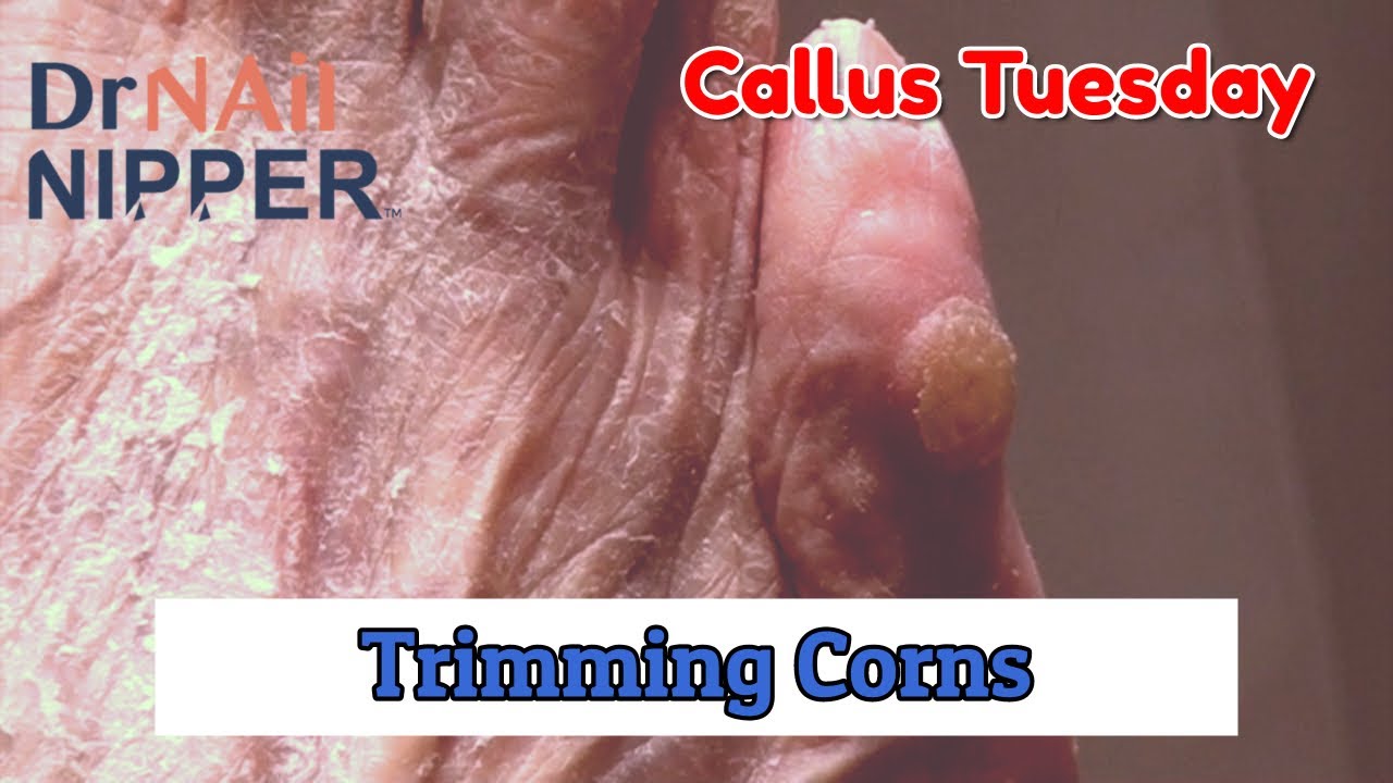 Trimming Corns - BONUS on Callus Tuesday (2020) 5