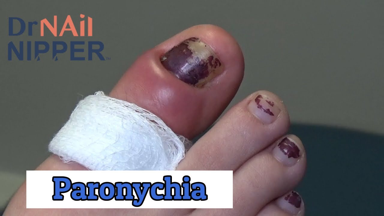Dr Nail Nipper Special Saturday - Paronychia (2020) 1
