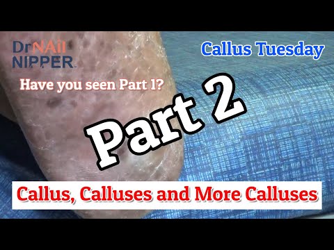 Callus, Calluses, and More Calluses on Right Foot - Part 2 [Callus Tuesday] (2020) 1
