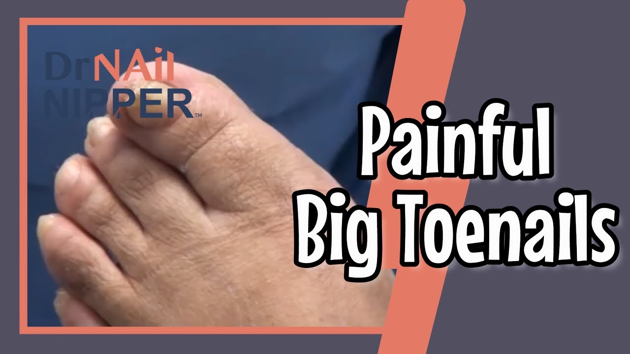 Painful Big Toenails 4