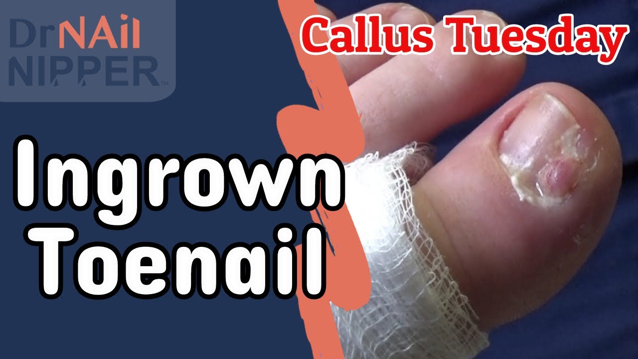 Ingrown Toenail for Callus Tuesday (2020) 2