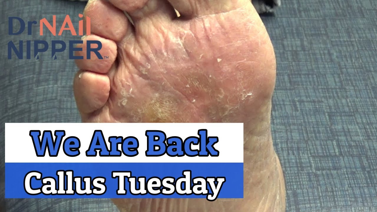 Corns on a Callus Tuesday (2020) 5