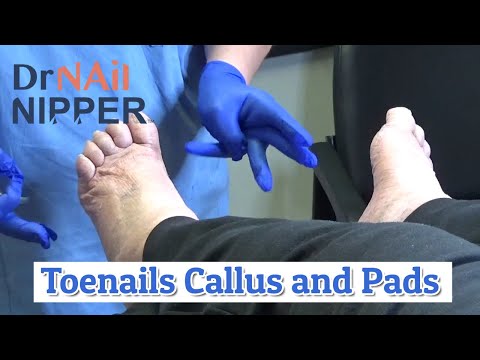 Toenails, Foot Calluses and Foot Pads [link moved] (2020) 1