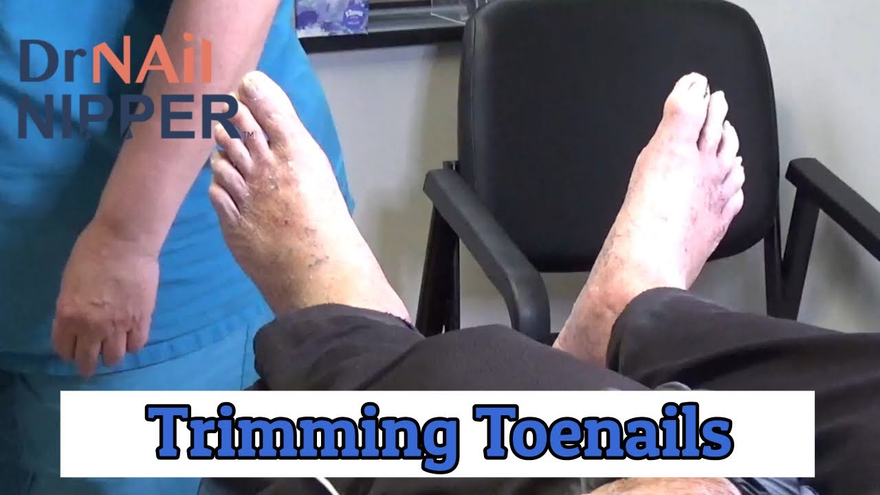Trimming Toenails with Dr Nail Nipper (2020) 1