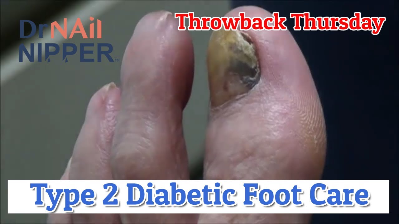 Type 2 Diabetic Foot Care [Throwback Thursday] 2