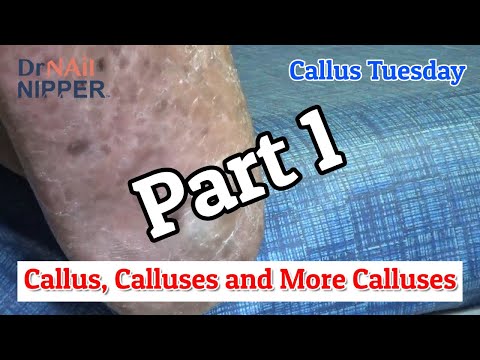 Callus, Calluses and More Calluses on Right Foot - Part 1 [Callus Tuesday] (2020) -- Moved the Link 1