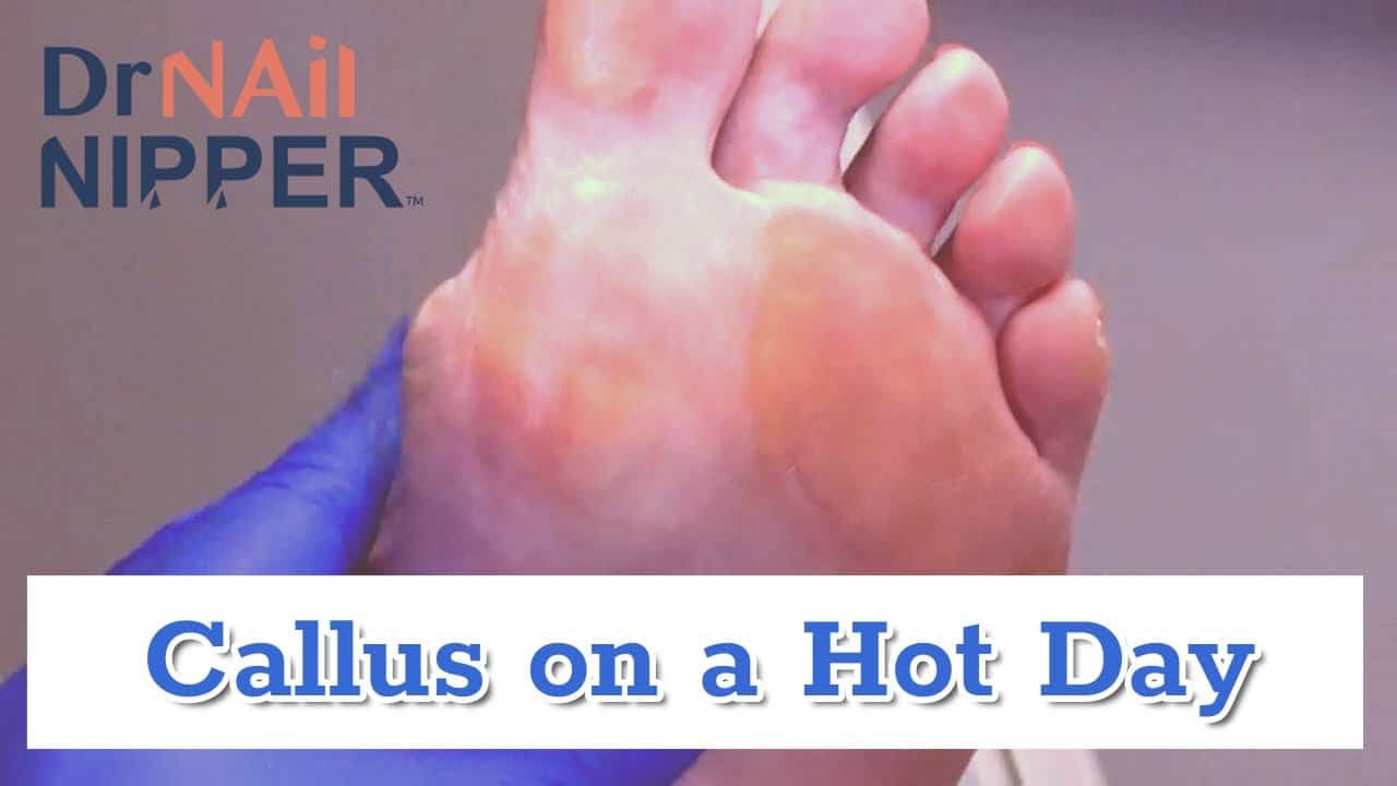 Hot Calluses or Hot Air? (link is moved) [Callus Tuesday Replay] (2020) 1