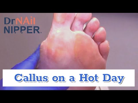 Hot Calluses? Is that a thing? [Callus Tuesday] (2020) 1