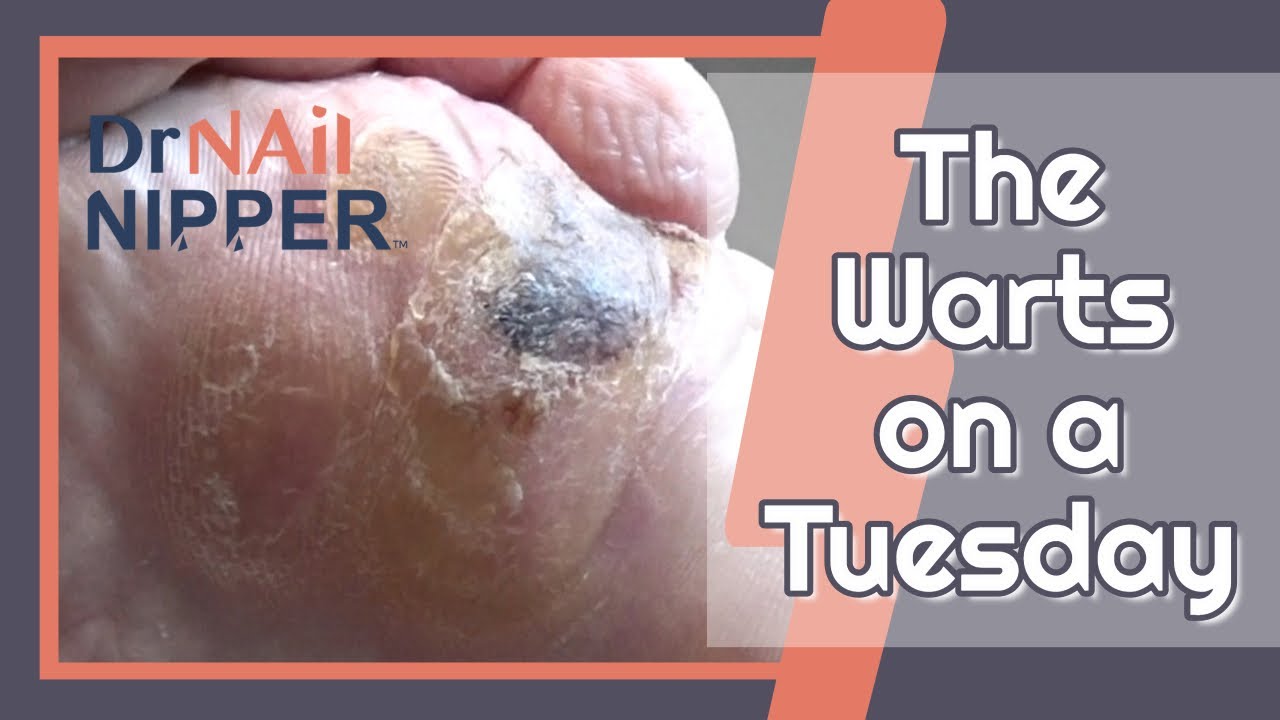 Emily and Warts are back on a Tuesday (2020) 6