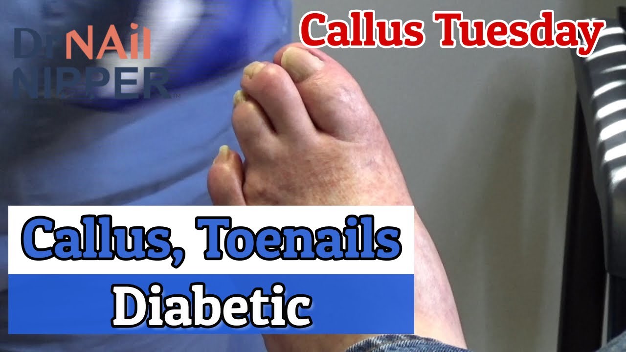 Calluses and Diabetic Toenails [Callus Tuesday] (2020) 2