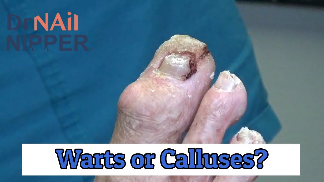 Callus Tuesday on a Thursday (2020) 5