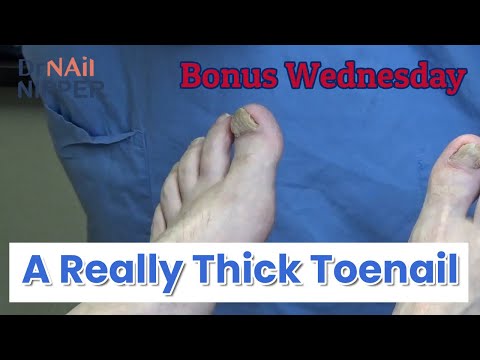 A Really Thick Toenail [Moving the Video Link] (2020) 1