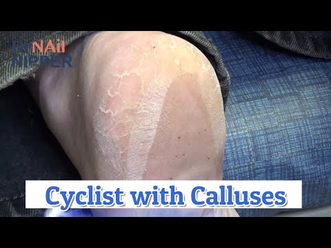 Return of the Cyclist with Callus [Callus Tuesday] (2020) 1