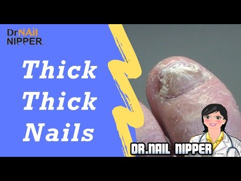 Thick Thick Toenail [Premiere Friday] (2019) 1