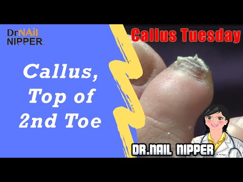 Callus, Tip of the 2nd Toe #54 [Callus Tuesday] (2019) 1