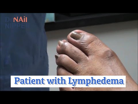 Dr Nail Nipper Lymphedema [Throwback Thursday] 1