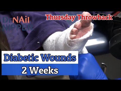 Diabetic Wounds for 2 Weeks - [moving links around] 1