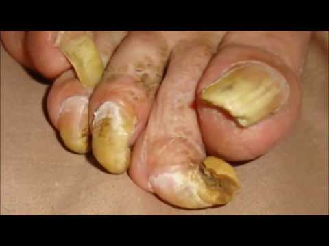 Rams Horn Nail Removal, Ingrown Nails - Dr Nail Nipper Preview 1