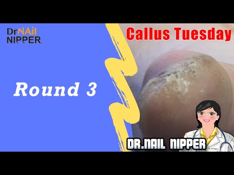 Big Toe Callus - Round 3? Callus is Tamed by Dr Nail Nipper #53 - [Callus Tuesday] (2019) 1