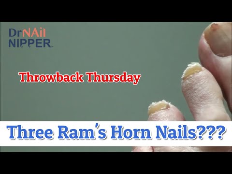 Three Ram's Horn Toenails [Throwback Thursday] 1