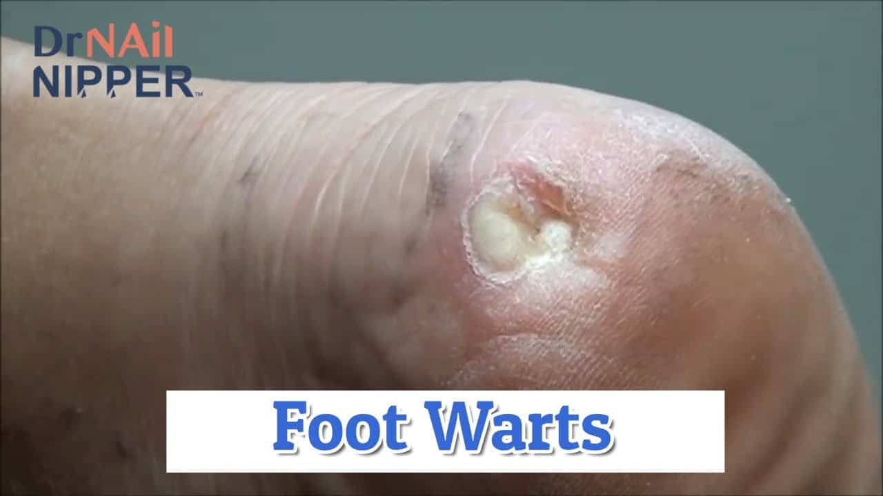 Foot Warts [Throwback Thursday Double] 2