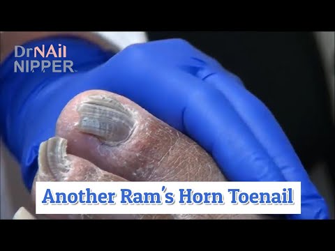 Baby Small Toe Ram's Horn Toenail [Throwback Wednesday] 1