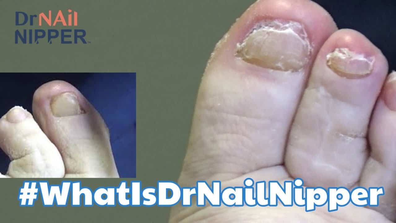 Toenails, Calluses ... What is Dr Nail Nipper discussing today? (2020) 6