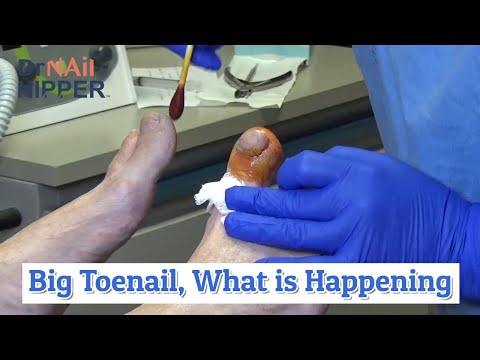 What is Dr Nail Nipper working on? [Callus Tuesday] (2020) 1