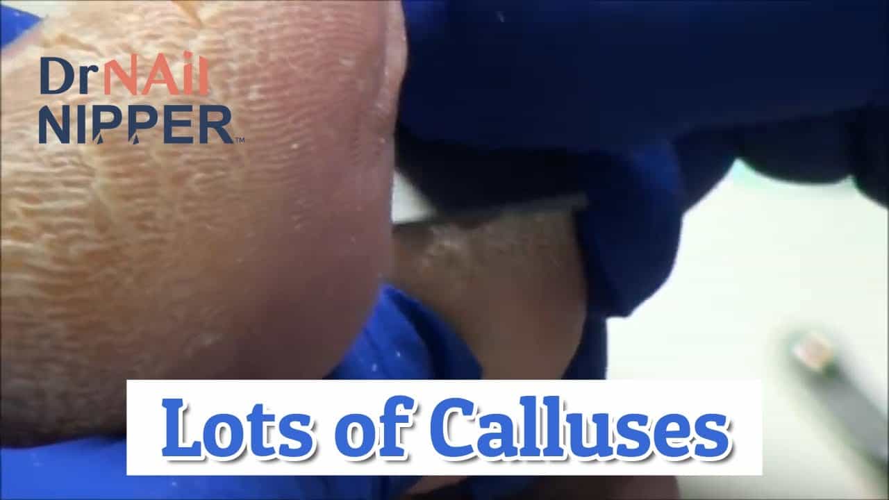 Lots of Calluses with a Nice Patient, Neuropathy [Throwback Thursday] 3