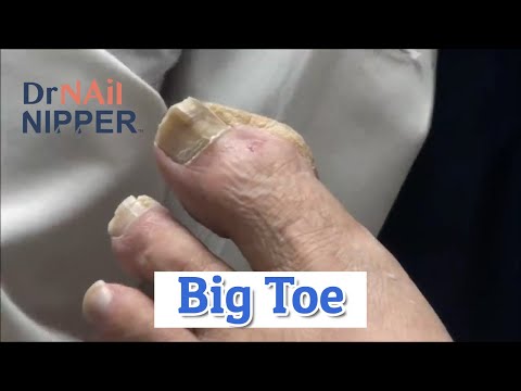 Big Toes and Toenails with a Nice Patient [Throwback Thursday Bonus] 1