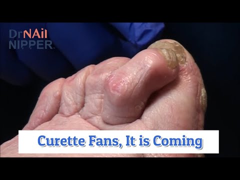 Curette Fans, It is Coming Out - A Patient with Everything Going On [Throwback Thursday] 1