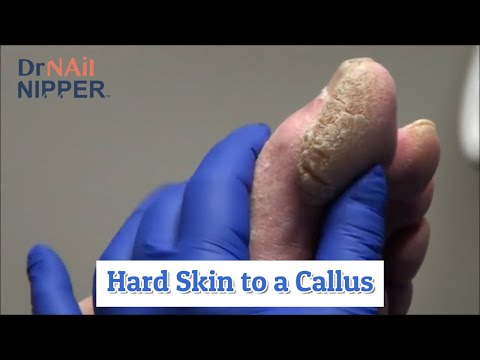 Hard Skin to a Callus [Thursday Throwback] 1