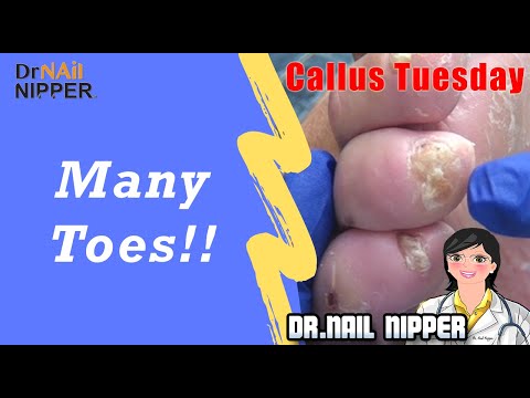 Many Toes? With a Callus [Callus Tuesday] (2019) 1