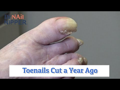 Toenails Cut a Year Ago (2020) 1