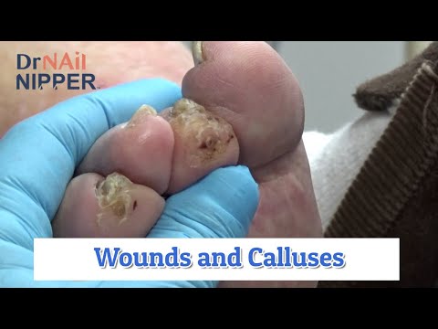 Foot Wounds and Calluses - Healing? [Callus Tuesday] (2020) 1