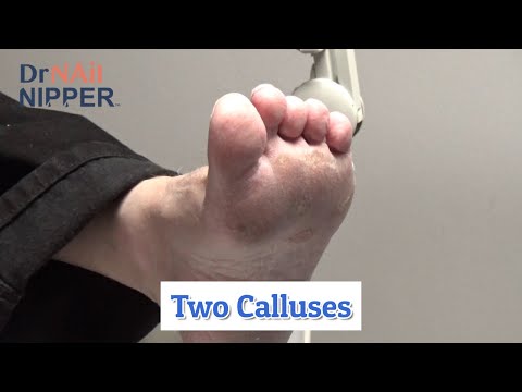 2 Calluses and Dr Nail Nipper's Resident [Callus Tuesday] (2020) 1