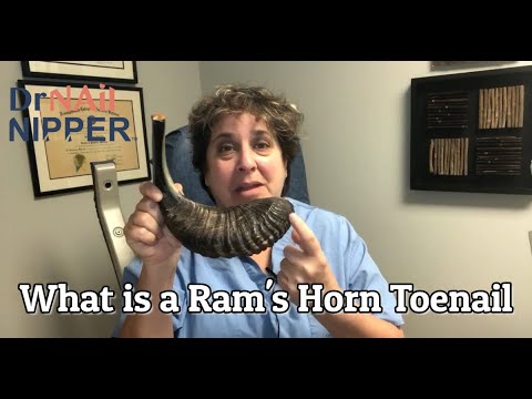 Dr Nail Nipper Explains a Ram's Horn Toenail (2020) 2