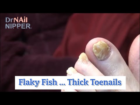 What Flaky Toenails for a Thick Fisherman? You betcha [Throwback Thursday] 1