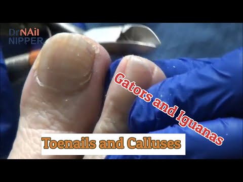 Gators, Iguanas and Toenails and Calluses [Throwback Thursday] 1