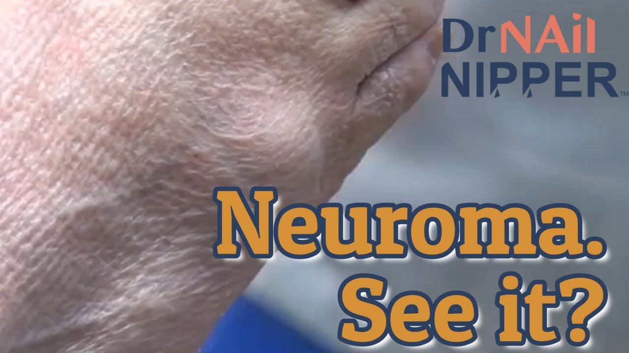 Morton's Neuroma. It is the 21st, it must time for a Neuroma video [Throwback Wednesday] 1