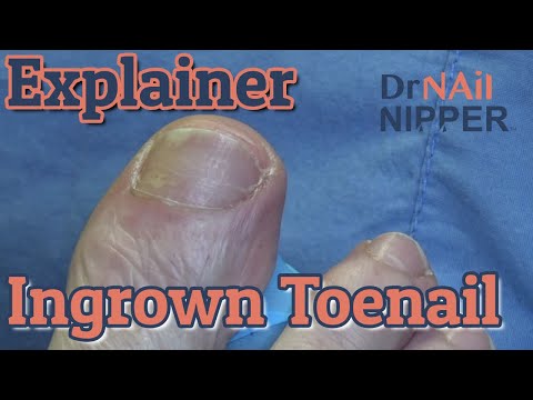 Dr Nail Nipper Explains Ingrown Toenails [Callus Tuesday] (2020) 1