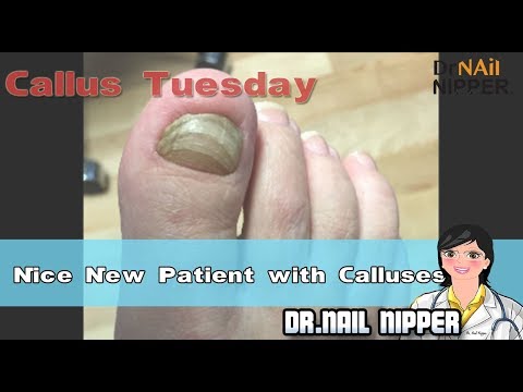 Calluses and Neuropathy with Nice New Patient #7 - [Callus Tuesday] (2018) 1